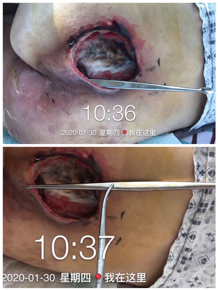 一例骶尾部巨大压疮的救治历程