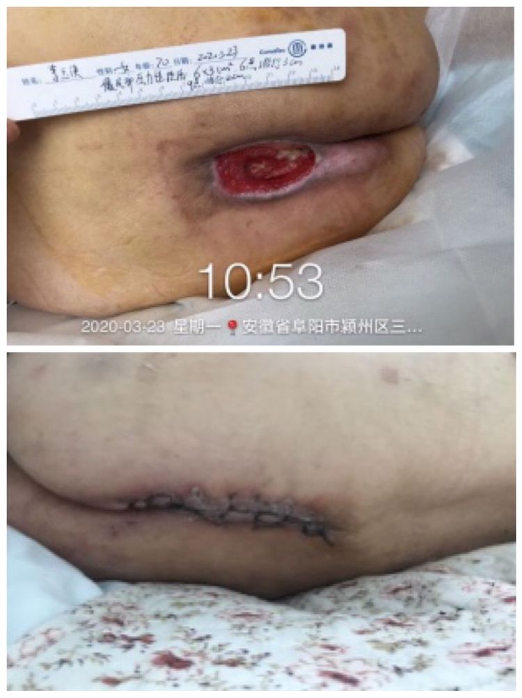 一例骶尾部巨大压疮的救治历程